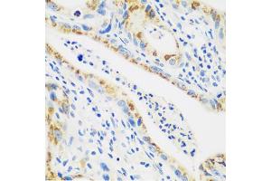 Immunohistochemistry of paraffin-embedded human stomach cancer using CTSG antibody (ABIN5974986) at dilution of 1/100 (40x lens). (Cathepsin G Antikörper)