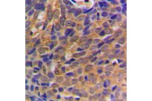 Immunohistochemical analysis of Beta-catenin staining in human breast cancer formalin fixed paraffin embedded tissue section. (beta Catenin Antikörper  (N-Term))