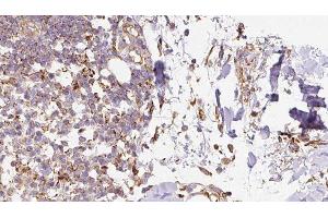 ABIN6276656 at 1/100 staining Human Melanoma tissue by IHC-P. (Ghrelin Antikörper  (C-Term))