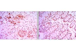 Immunohistochemical analysis of paraffin-embedded colon cancer tissues (left) and human larynx cancer tissues (right) using KDM4A mouse mAb with DAB staining. (KDM4A Antikörper)
