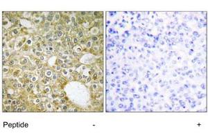 Immunohistochemistry analysis of paraffin-embedded human breast carcinoma tissue using ACVRL1 polyclonal antibody . (ACVRL1 Antikörper)