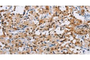 Immunohistochemistry of paraffin-embedded Human thyroid cancer using ATXN1 Polyclonal Antibody at dilution of 1:40 (Ataxin 1 Antikörper)