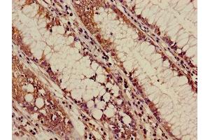 Immunohistochemistry of paraffin-embedded human colon cancer using ABIN7144542 at dilution of 1:100 (ALOX5 Antikörper  (AA 2-149))