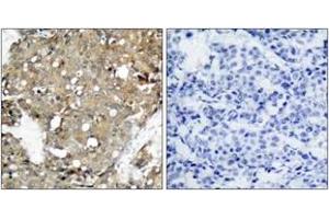 Immunohistochemistry analysis of paraffin-embedded human breast carcinoma tissue, using STAT1 (Ab-727) Antibody. (STAT1 Antikörper  (AA 694-743))