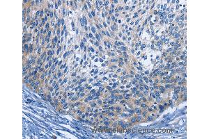 Immunohistochemistry of Human cervical cancer using IL2RB Polyclonal Antibody at dilution of 1:30 (IL2 Receptor beta Antikörper)
