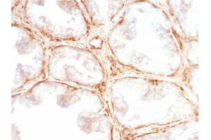 Formalin-fixed, paraffin-embedded human Prostate Carcinoma stained with Galectin-1 Monospecific Recombinant Rabbit Monoclonal Antibody (GAL1/2499R). (Rekombinanter LGALS1/Galectin 1 Antikörper  (AA 12-108))