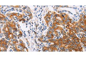 Immunohistochemistry of paraffin-embedded Human gastic cancer using CTNNA1 Polyclonal Antibody at dilution of 1:35 (CTNNA1 Antikörper)