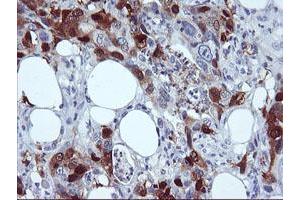 Immunohistochemical staining of paraffin-embedded Carcinoma of Human pancreas tissue using anti-SERPINB2 mouse monoclonal antibody. (SERPINB2 Antikörper)