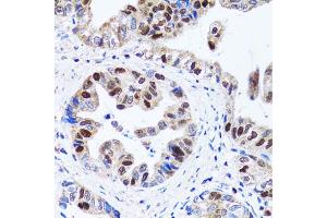 Immunohistochemistry of paraffin-embedded human gastric cancer using UHRF1 antibody. (UHRF1 Antikörper)