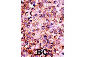Formalin-fixed and paraffin-embedded human cancer tissue reacted with PANK3 polyclonal antibody  , which was peroxidase-conjugated to the secondary antibody, followed by AEC staining.