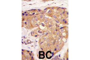 Formalin-fixed and paraffin-embedded human breast carcinoma tissue reacted with SOST polyclonal antibody  , which was peroxidase-conjugated to the secondary antibody, followed by DAB staining. (Sclerostin Antikörper  (N-Term))