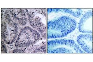 Immunohistochemical analysis of paraffin-embedded human colon carcinoma tissue, using IKKα (Ab-23) antibody (E021123). (IKK alpha Antikörper)
