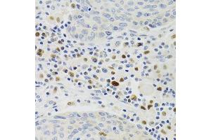 Immunohistochemistry of paraffin-embedded human lung cancer using GEMIN2 Antibody. (SIP1 Antikörper)