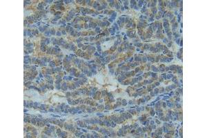 IHC-P analysis of thyroid cancer tissue, with DAB staining. (IL1RN Antikörper  (AA 26-177))