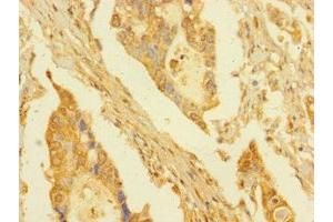 Immunohistochemistry of paraffin-embedded human pancreatic cancer using ABIN7165304 at dilution of 1:100 (DPY30 Antikörper  (AA 1-99))