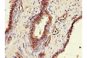 Immunohistochemistry of paraffin-embedded human prostate cancer using ABIN7170330 at dilution of 1:100 (SORD Antikörper  (AA 201-357))