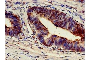 Immunohistochemistry of paraffin-embedded human colon cancer using ABIN7143447 at dilution of 1:100 (ARF4 Antikörper  (AA 1-180))