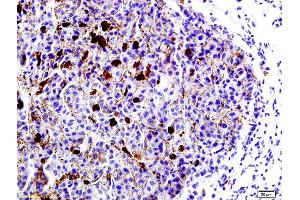 Formalin-fixed and paraffin embedded mouse lung cancer labeled with Anti-LRP1/CD91 Polyclonal Antibody, Unconjugated (ABIN748988) at 1:200 followed by conjugation to the secondary antibody and DAB staining (LRP1 Antikörper  (AA 4451-4545))