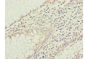 Immunohistochemistry of paraffin-embedded human colon cancer using ABIN7156905 at dilution of 1:100 (IL1F9 Antikörper  (AA 1-169))