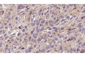 ABIN6272299 at 1/100 staining Human Melanoma tissue by IHC-P. (FGF22 Antikörper  (Internal Region))