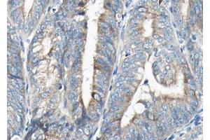 ABIN6268798 at 1/100 staining human Endometrial cancer tissue sections by IHC-P.