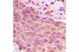 Immunohistochemical analysis of NF-kappaB p65 (pS536) staining in human breast cancer formalin fixed paraffin embedded tissue section.