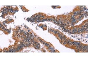 Immunohistochemistry of paraffin-embedded Human colon cancer using IRAK1BP1 Polyclonal Antibody at dilution of 1:40 (IRAK1BP1 Antikörper)