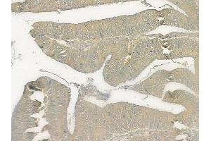 ABIN6258086 and ABIN6273824 at 1/100 staining human renal cell carcinoma by IHC-P.