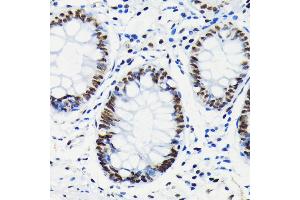 Immunohistochemistry of paraffin-embedded human colon using Phospho-Rb-S780 antibody (ABIN7269936) at dilution of 1:100 (40x lens). (Retinoblastoma 1 Antikörper  (pSer780))