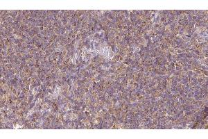 ABIN6273154 at 1/100 staining Human lymph cancer tissue by IHC-P. (RASGRP3 Antikörper  (Internal Region))