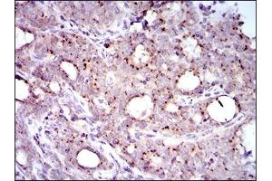 Immunohistochemical analysis of paraffin-embedded cervical cancer tissues using MRPL42 mouse mAb with DAB staining. (MRPL42 Antikörper  (AA 142-203))
