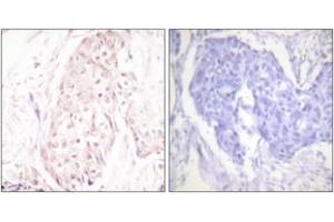 Immunohistochemistry analysis of paraffin-embedded human breast carcinoma tissue, using SENP8 Antibody. (SENP8 Antikörper  (AA 161-210))