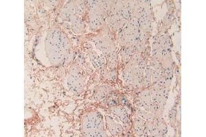 IHC-P analysis of Human Esophagus Cancer Tissue, with DAB staining. (COL6a3 Antikörper  (AA 463-624))