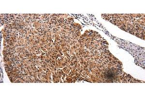 Immunohistochemistry of paraffin-embedded Human renal cancer tissue using RAB41 Polyclonal Antibody at dilution 1:100