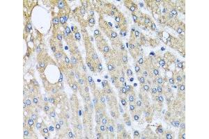 Immunohistochemistry of paraffin-embedded Human liver damage using UQCRC2 Polyclonal Antibody at dilution of 1:100 (40x lens). (UQCRC2 Antikörper)
