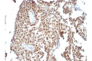 Formalin-fixed, paraffin-embedded human Bladder Carcinoma stained with p53 Monoclonal Antibody (SPM590) (p53 Antikörper)