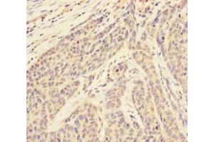 Immunohistochemistry of paraffin-embedded human ovarian cancer using ABIN7170628 at dilution of 1:100 (RBM17 Antikörper  (AA 1-240))