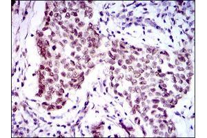 Immunohistochemical analysis of paraffin-embedded breast cancer tissues using FOXP1 mouse mAb with DAB staining. (FOXP1 Antikörper  (AA 481-677))