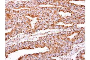 IHC-P Image PACSIN2 antibody [N2C3] detects PACSIN2 protein at cytosol on human colon carcinoma by immunohistochemical analysis. (PACSIN2 Antikörper)