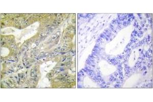 Immunohistochemistry analysis of paraffin-embedded human colon carcinoma tissue, using HEXB Antibody.