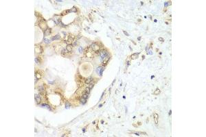 Immunohistochemistry of paraffin-embedded human liver cancer using VTI1B antibody (ABIN6132781, ABIN6150162, ABIN6150163 and ABIN6222854) at dilution of 1:100 (40x lens). (VTI1B Antikörper  (AA 1-210))
