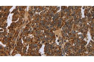 Immunohistochemistry of paraffin-embedded Human ovarian cancer tissue using NEFH Polyclonal Antibody at dilution 1:40 (NEFH Antikörper)