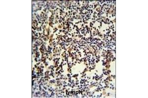 ANR49 Antibody (Center) (ABIN651157 and ABIN2840103) IHC analysis in formalin fixed and paraffin embedded human lymph carcinoma followed by peroxidase conjugation of the secondary antibody and DAB staining. (ANKRD49 Antikörper  (AA 80-109))