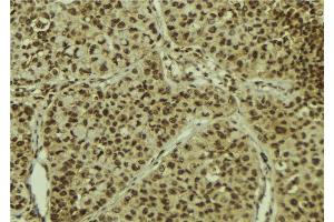 ABIN6278395 at 1/100 staining Human breast cancer tissue by IHC-P. (MGEA5 Antikörper)