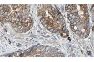 ABIN6274467 at 1/100 staining Human prostate tissue by IHC-P. (PMEPA1 Antikörper  (Internal Region))