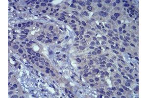 Immunohistochemical analysis of paraffin-embedded esophageal cancer tissues using LEF1 mouse mAb with DAB staining. (LEF1 Antikörper  (AA 33-138))
