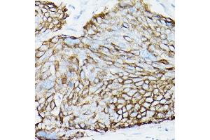 Immunohistochemistry of paraffin-embedded Human cervical squamous cell carcinoma using MUC1 Rabbit mAb (ABIN7268687) at dilution of 1:100 (40x lens). (MUC1 Antikörper)