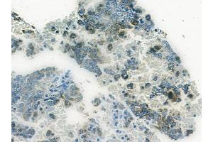 ABIN6265247 and ABIN6272432 at 1/100 staining human melanoma by IHC-P. (Sp3/4 Antikörper  (C-Term))