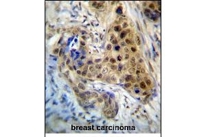 RPL3 Antibody (Center) (ABIN657323 and ABIN2846397) immunohistochemistry analysis in formalin fixed and paraffin embedded human breast carcinoma followed by peroxidase conjugation of the secondary antibody and DAB staining. (RPL3 Antikörper  (AA 224-251))