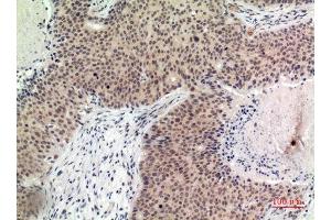 Immunohistochemistry (IHC) analysis of paraffin-embedded Human Breast Cancer, antibody was diluted at 1:100. (Histone H2B Antikörper  (Internal Region))